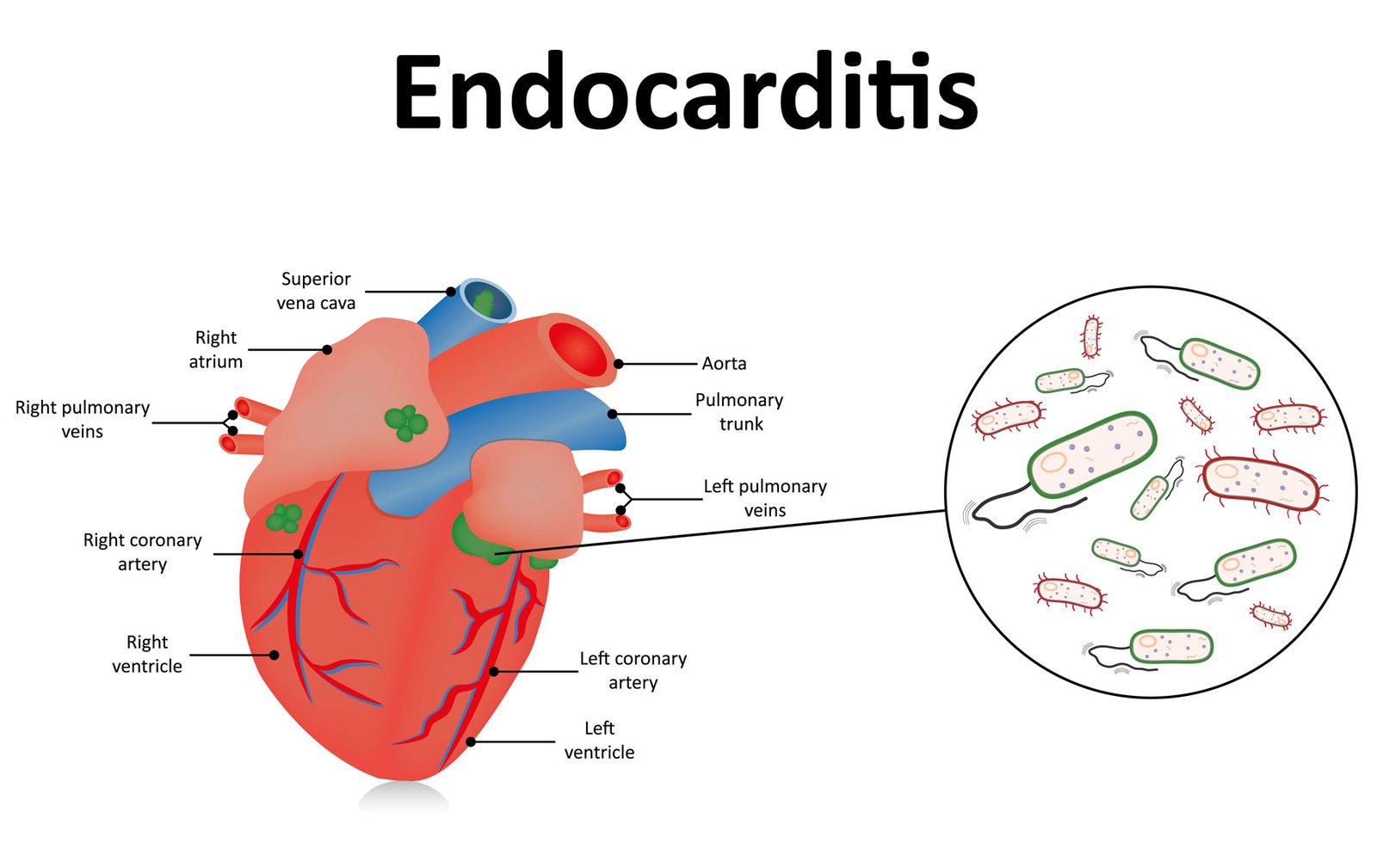 Infective Endocarditis | Trust Dents