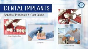Dental Implants: Benefits, Procedure & Cost Guide