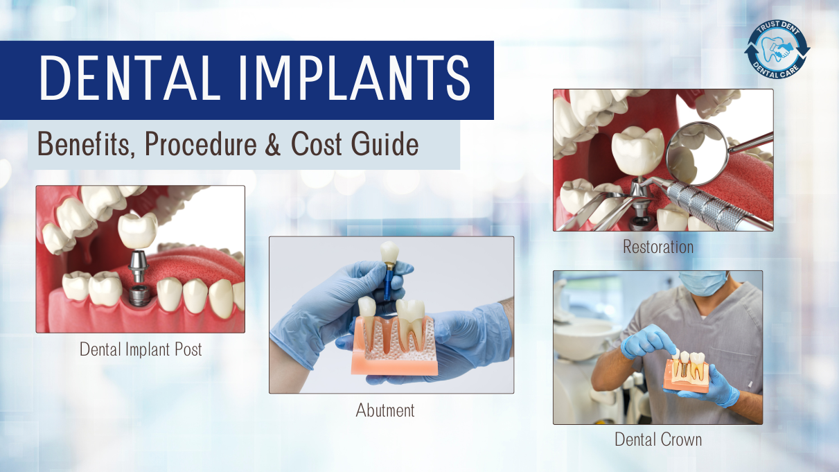 Dental Implants: Benefits, Procedure & Cost Guide