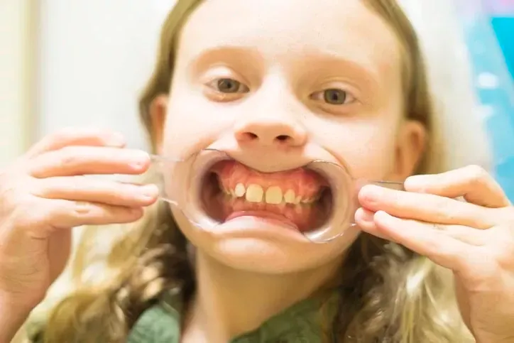 Crossbite