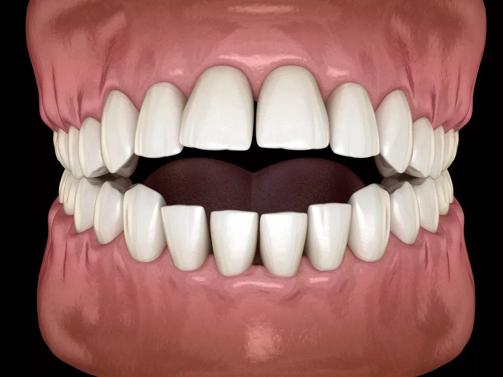 Overbite