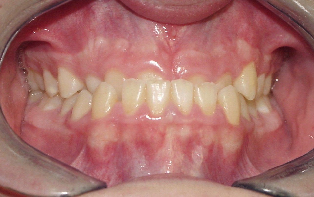 Underbite