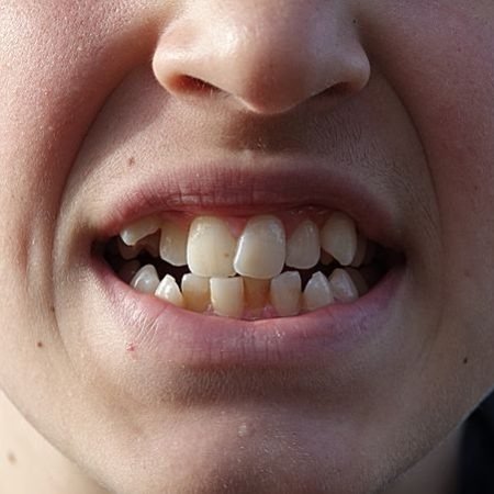 Crowded Teeth